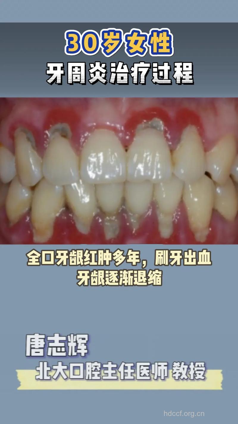 牙周炎的治疗