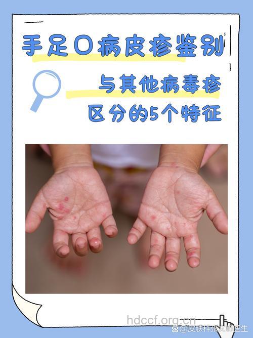 全面的了解手足口病特征
