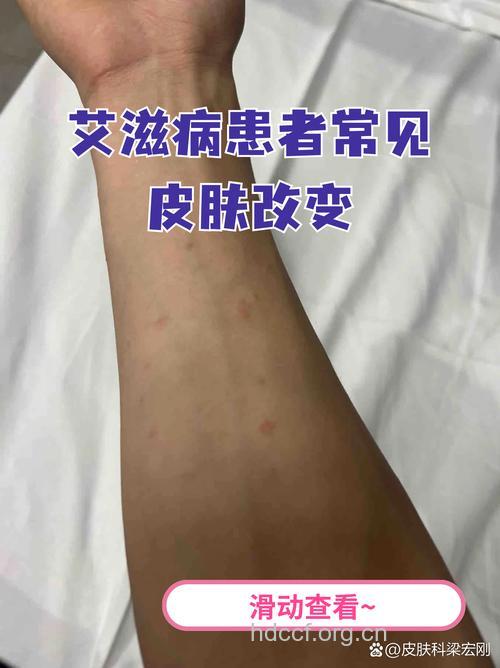 艾滋病患者的临床表现多样