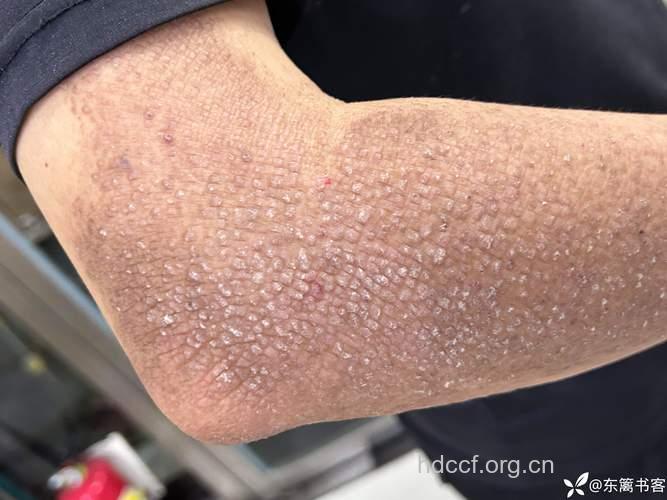 工业性皮肤病临床表现