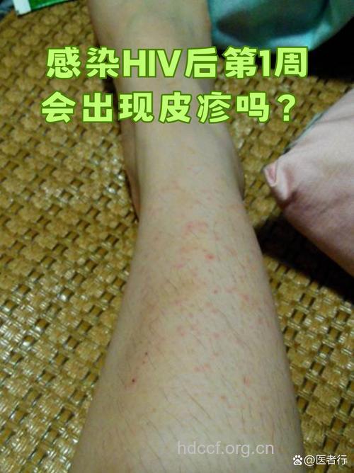 艾滋病急性感染期有什么症状