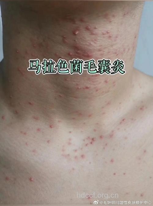 病例解析：糠秕孢子菌毛囊炎