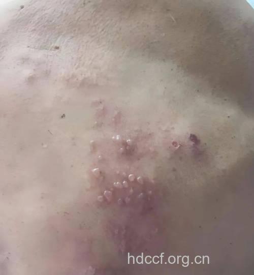 带状疱疹治愈全过程