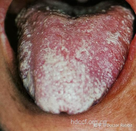 艾滋病早期口腔特殊症状 毛状白斑