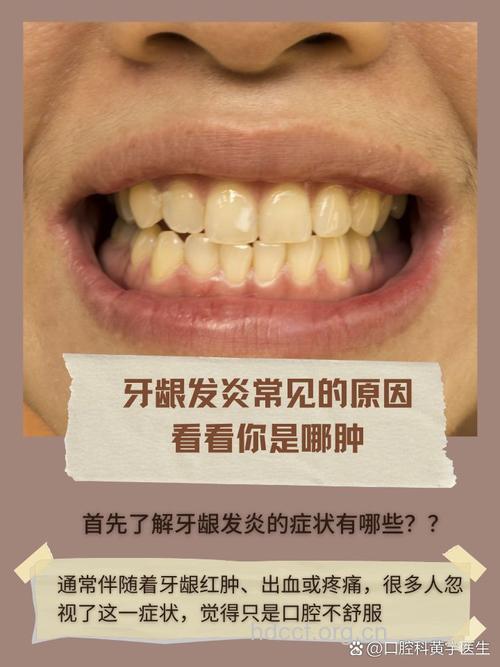 女人更易发生牙龈炎的原因