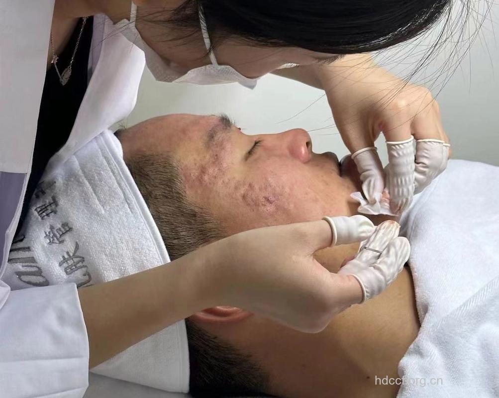 中医针灸法 治痤疮不含糊