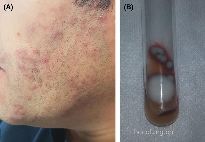 案例：治疗须癣毛癣菌致体癣