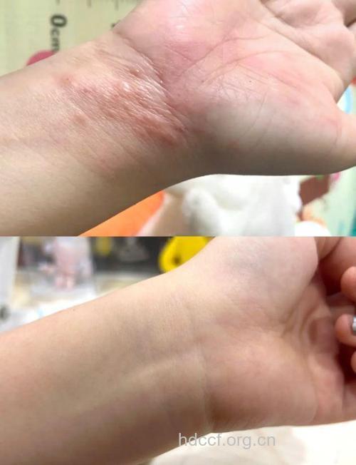 治疗过敏性荨麻疹全过程