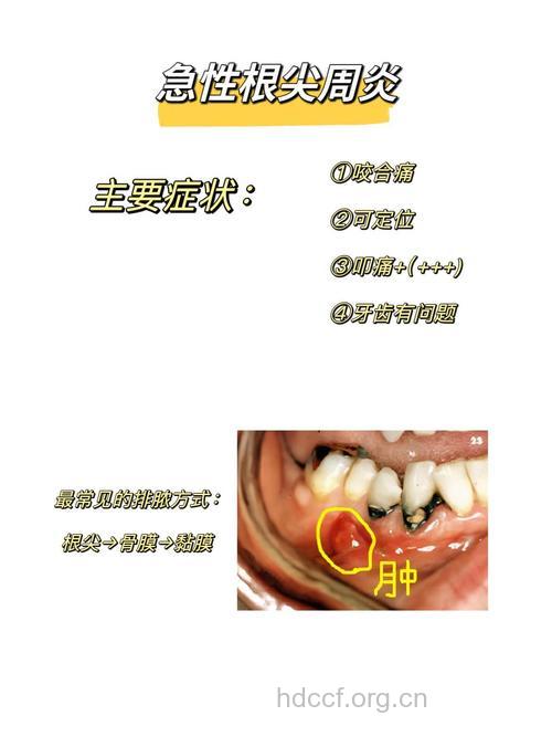 何为急性浆液性根尖周炎