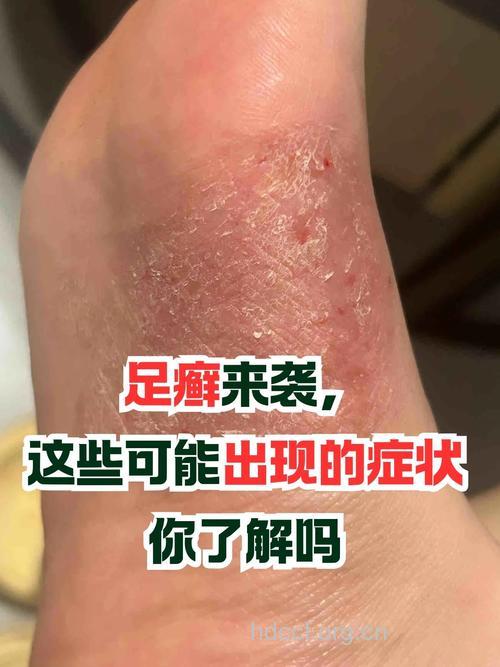 足癣竟然能引发阴部瘙痒