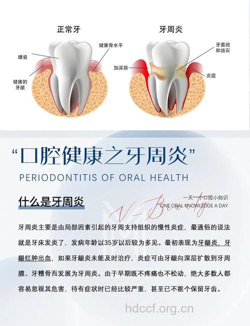 牙周病是口腔疾病首要杀手