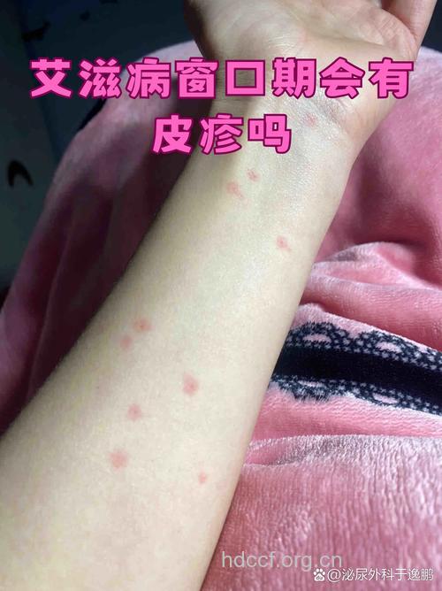 艾滋病窗口期低烧症状