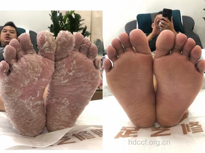 治疗足癣 双管齐下