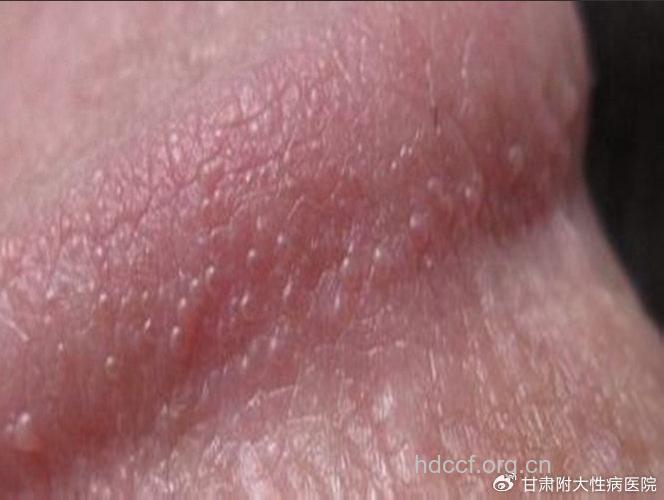 男性艾滋病早期龟头症状