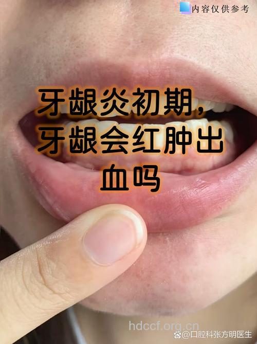 女性最易换牙龈炎的时期