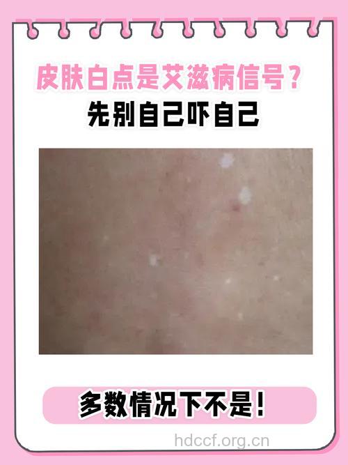 白癜风是艾滋病早期皮肤症状吗