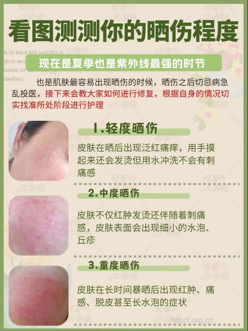 夏季皮肤晒伤要如何护理