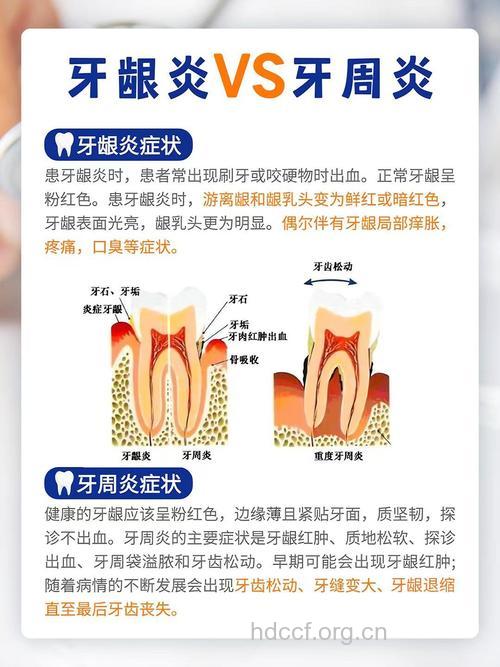 牙龈炎与牙周炎的区别 如何治疗牙龈炎