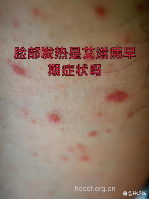 经常感冒是艾滋病初期症状吗