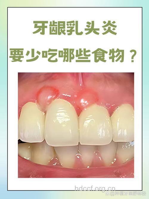 吃生蔬菜 八个牙龈炎的预防小妙招