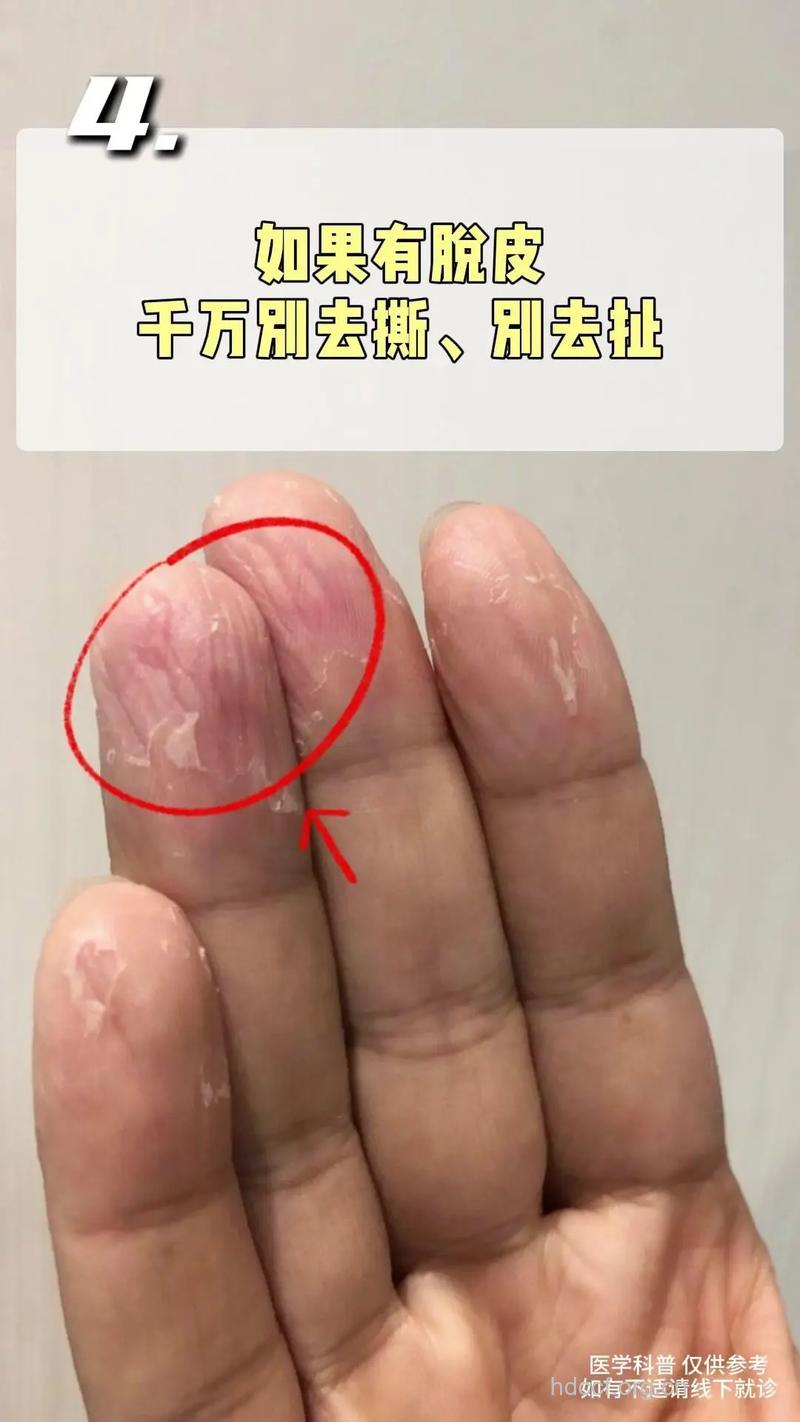 冬季手脱皮 5大方法有效缓解