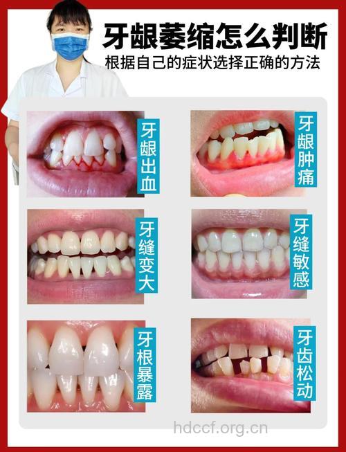 牙龈为何会退缩 如何治疗