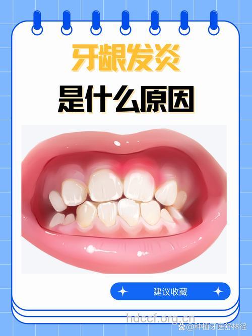 为何会有牙龈炎 竟是它引起的