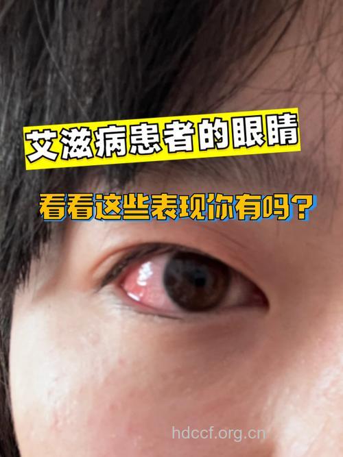 艾滋病眼部症状临床表现（一）