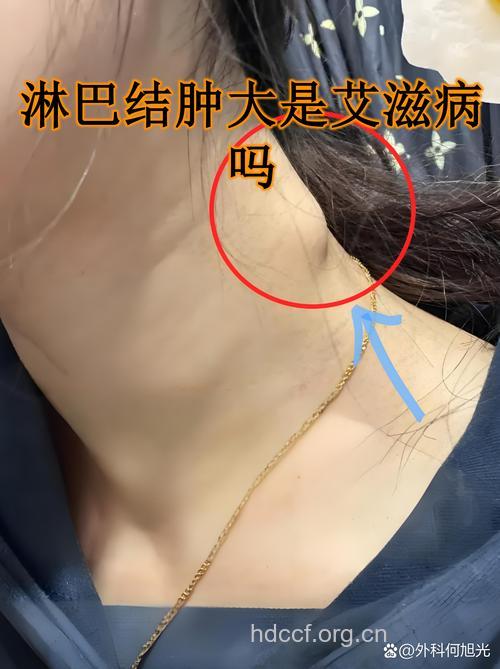 高危后淋巴结肿大是艾滋病症状吗