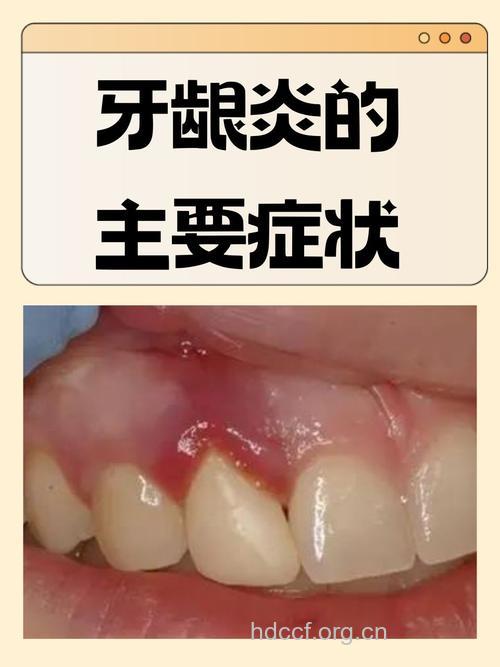 牙龈炎的典型症状有哪些