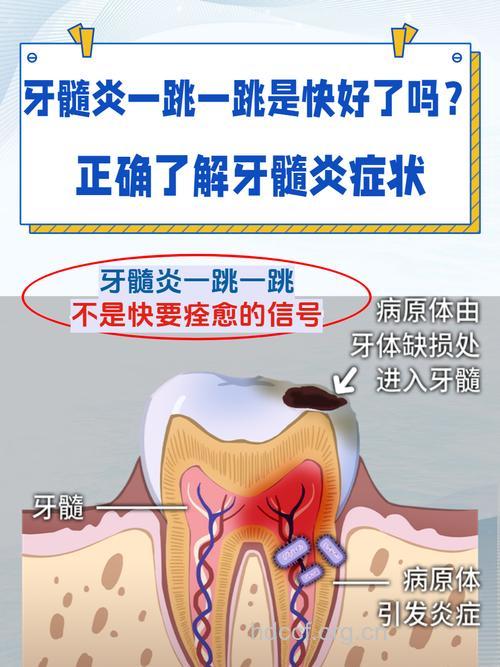 急性牙髓炎主要表现有哪些