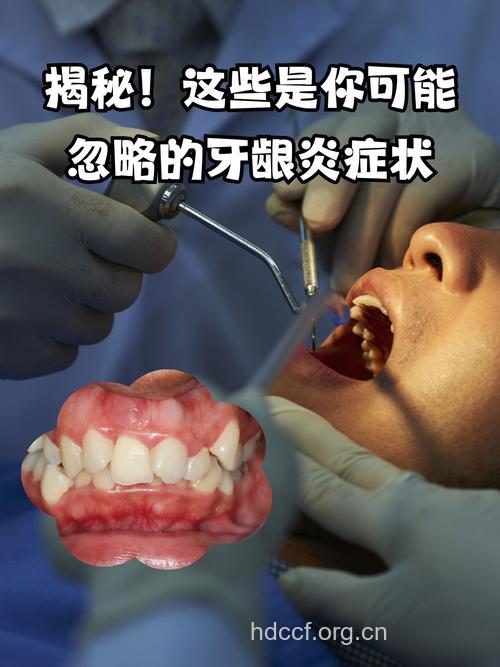 研究发现：牙龈炎会增加脑中风的危险