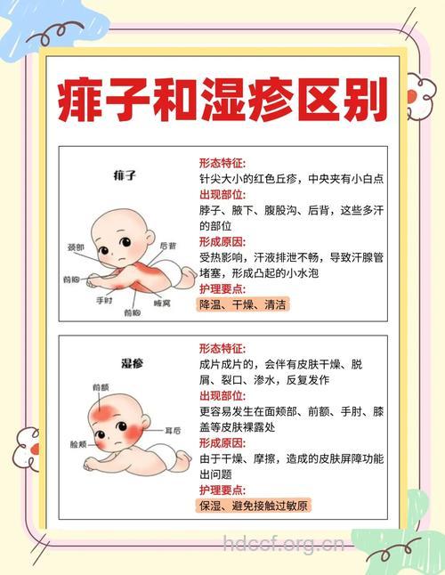 夏季有哪些治疗痱子方法
