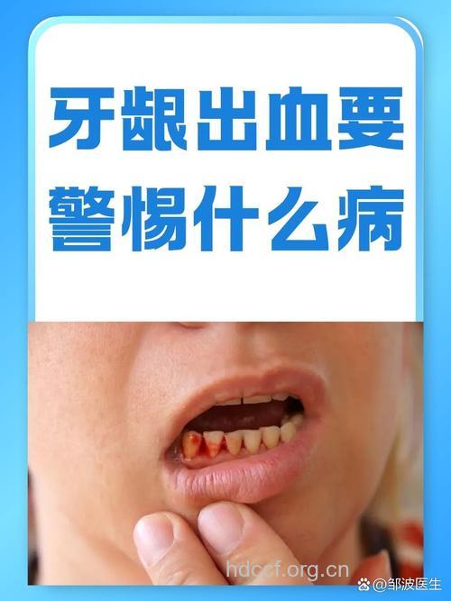 牙龈出血小心是牙龈炎