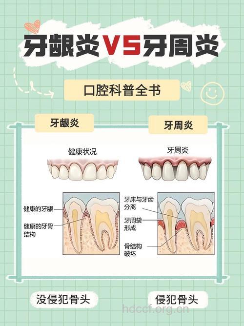 牙龈炎和牙周炎的区别表现