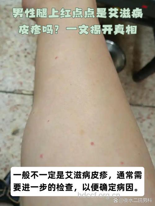 全身痒是艾滋病早期症状吗