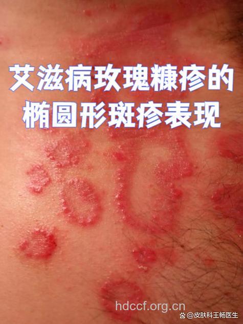 艾滋病早期症状 红色斑丘疹