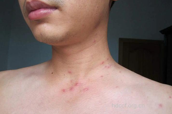 艾滋病急性期的典型症状