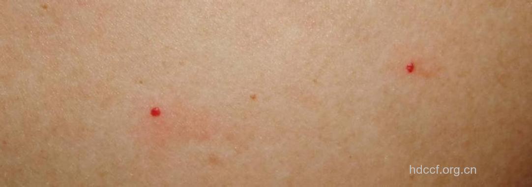 艾滋病皮下出血点是什么样的