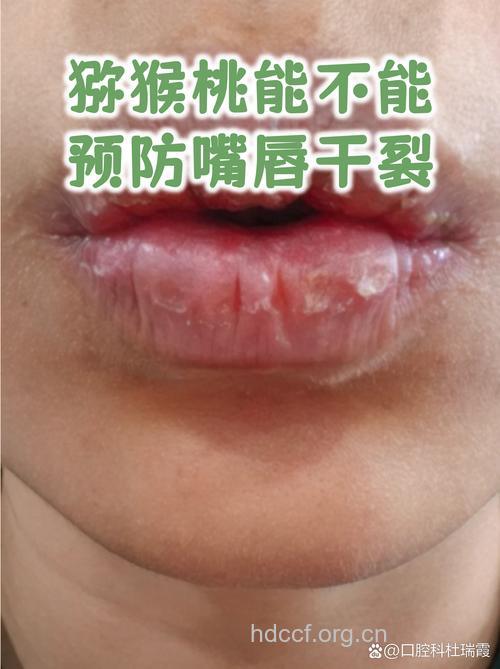 嘴唇干裂吃什么好 试试这六种食物