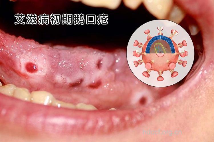艾滋病早期症状之鹅口疮疾病