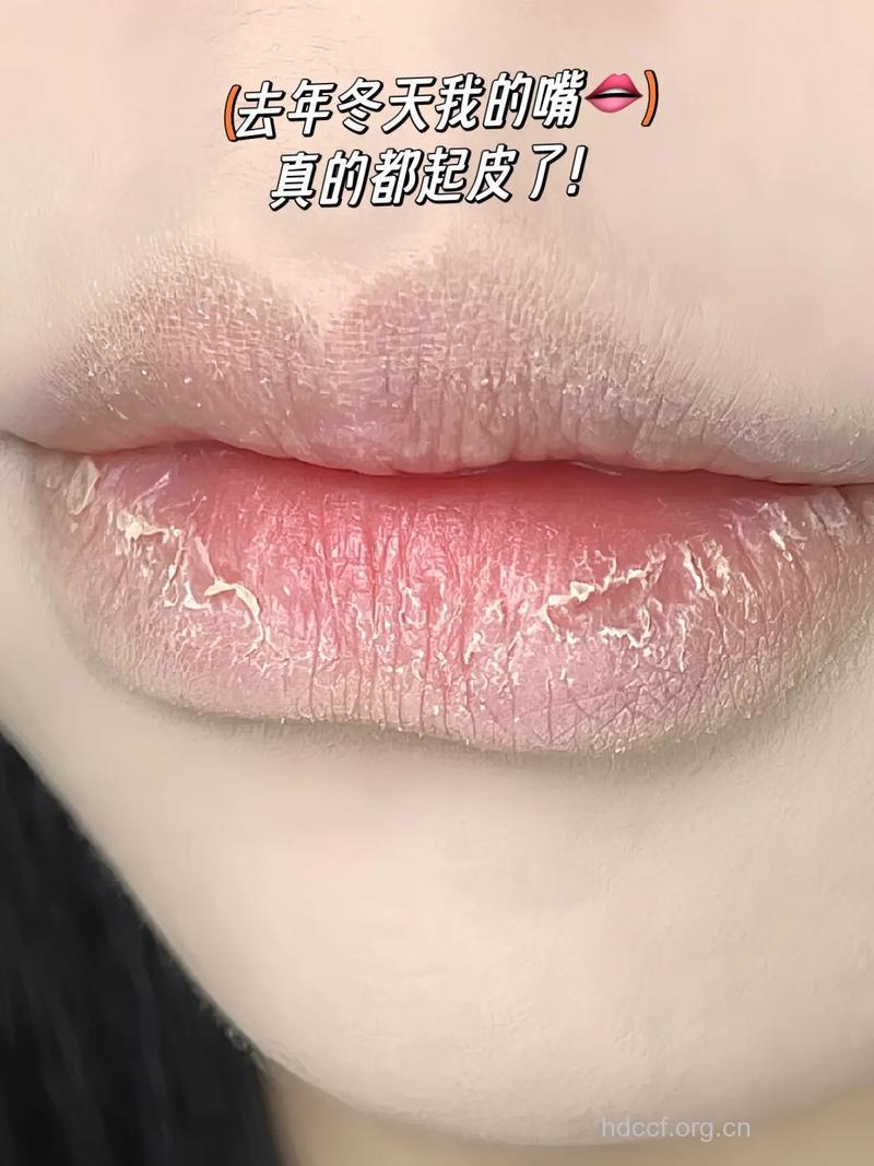 哪些美食能够赶走嘴唇干裂