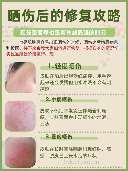 疾病百科 晒伤是从何而来呢