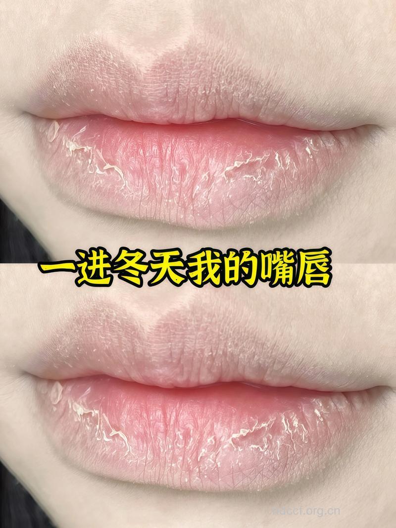 冬天嘴唇干裂吃什么好？