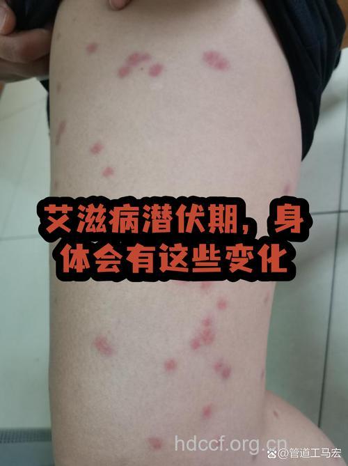 艾滋病潜伏期会让人变瘦