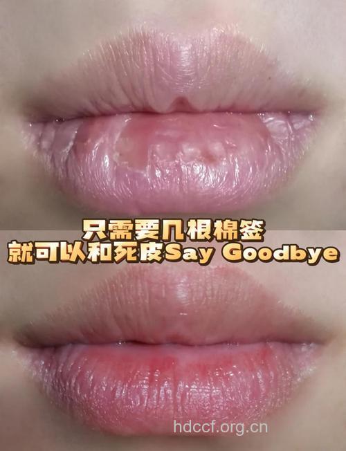 网友分享去嘴唇死皮妙招