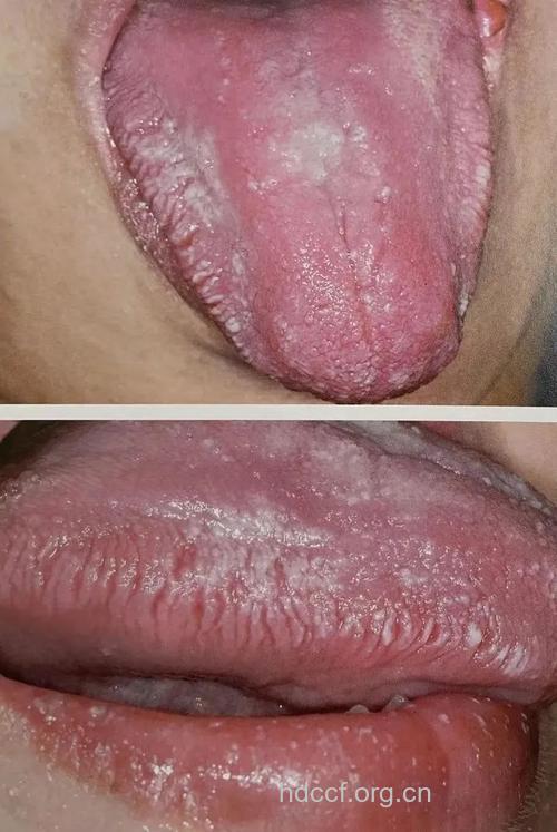 艾滋病早期舌头有哪些症状