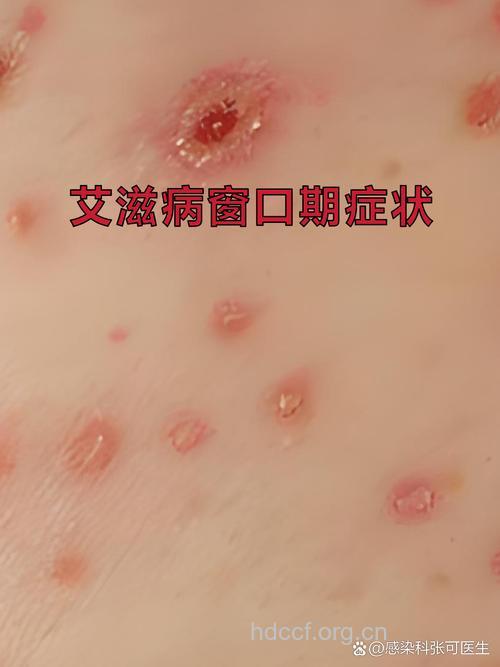 艾滋病窗口期常见的急性症状