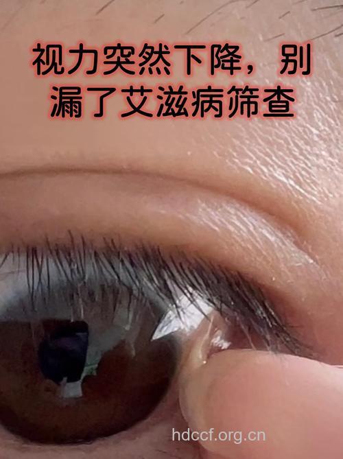 10天时间视力下降失明 确诊为艾滋病