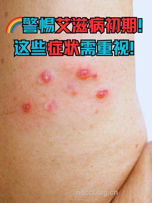 艾滋病患者共有的5个症状特点